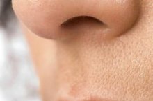 Difference Between Blackheads & Sebaceous Filaments