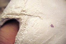What Is a Soft Ankle Cast?