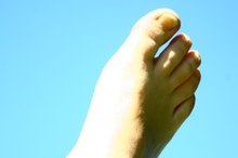 Toenail Cuticle Problems