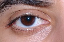 Redness on Eye Rim
