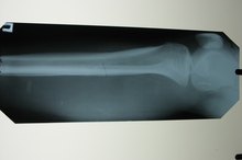 Air Cast Vs. Plaster