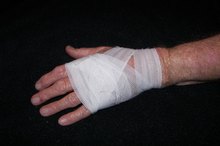 How to Treat Chemical Burns From Chlorine in Pools