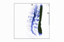Symptoms of Herpes of the Spine
