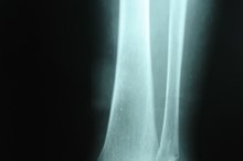 How to Inflate an Ankle Air Cast