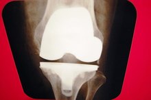 What Are the Causes of Poor Knee Circulation?