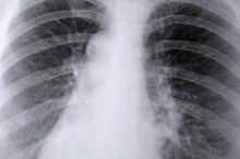 What Is Basilar Consolidation?