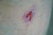 How to Remove Slough from a Wound