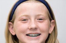 How to Remove Glue From Braces