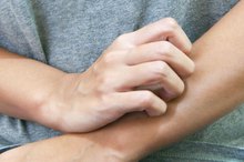 How to Get Rid of an Ant Bite in One Day