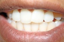 What Do Black Spots on Gums Mean?
