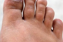 Taping Techniques for Morton's Neuroma