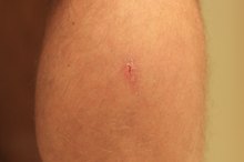 How to Get Rid of Leg Scars Caused by Picking at Scabs