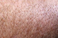 How to Tell If a Human Has Ear Mites