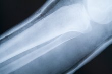 How to Clean an Air Cast