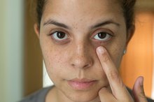 Home Remedies for Dark & Dry Skin Around the Eyes