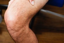 How to Remove Fluid From Knee Joints Naturally
