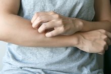 How to Make Tick Bites Stop Itching
