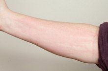 Cornstarch Home Remedy for Hives Itching