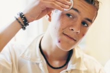 Does Adderall Cause Acne Breakouts?