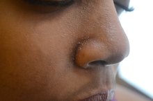 How to Get Rid of Dry Skin on My Nose