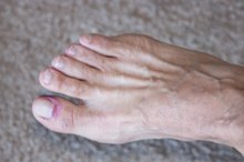 How to Soak an Infected Toe