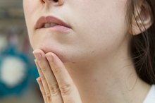 How to Clear Chin Acne