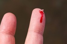 How to Remove a Piece of Glass from a Finger