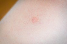 How to Remove Keloid Aspirin Paste