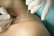 How to Remove a Filiform Wart