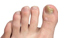 How to Soak the Feet for Toenail Fungus
