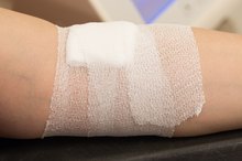 Healing Chemical Burned Skin
