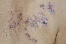 Bladder Symptoms From Shingles