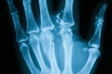 When Can You Go Back to Normal Activities After a Broken Finger?