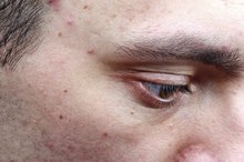 Facial Skin Blisters