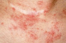 How to Remove Dead Skin From Psoriasis