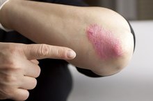Dry, Red Elbows
