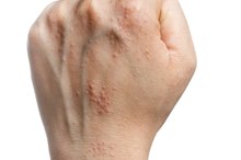 White, Itchy Marks Under the Skin of the Hands