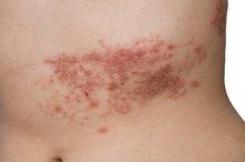 Acne & Shingles