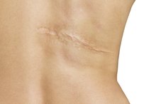 Skin Bleach for Scars