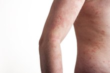 Foods to Avoid When You Have Atopic Dermatitis