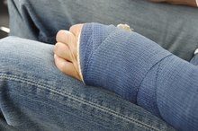 Do You Lose Arm Muscle After Wearing a Cast?