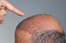 Dangers of Hair Transplants