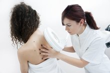Differences between Malignant Melanoma and a Normal Mole
