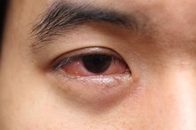 Puffy and Itchy Face from Allergies