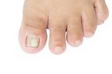 Vicks VapoRub & Toenail Fungus