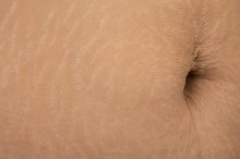Elasticity of Skin After Weight Loss
