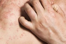 Common Shingles Rash Sites