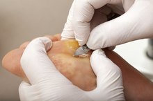 How to Treat Plantar Warts With Compound W