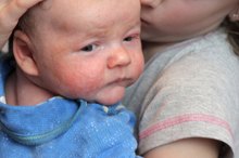 Eczema From Yeast