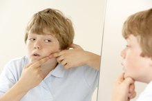 Psyllium Husks & Acne